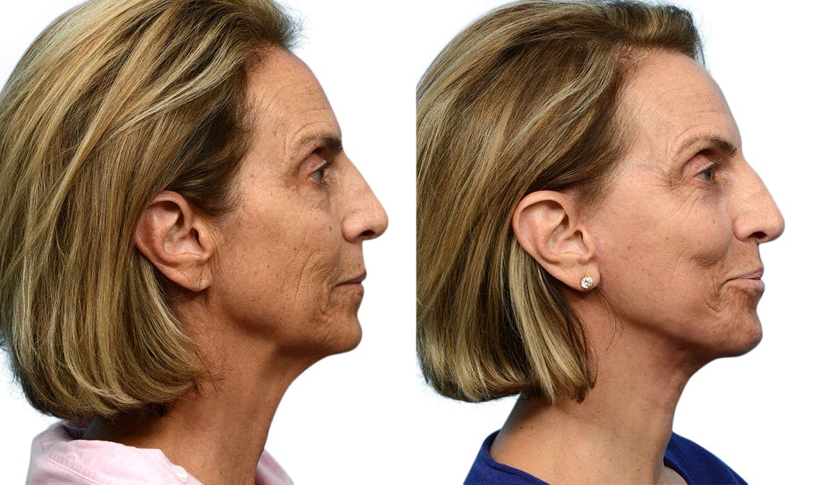 CO2 Laser Before & After Gallery - Patient 280830 - Image 1