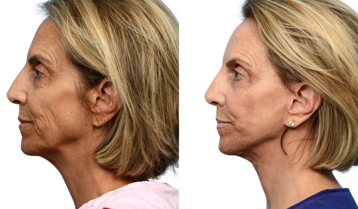 CO2 Laser Before & After Gallery - Patient 280830 - Image 2