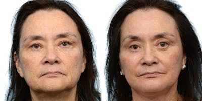 CO2 Laser Before & After Gallery - Patient 575206 - Image 1