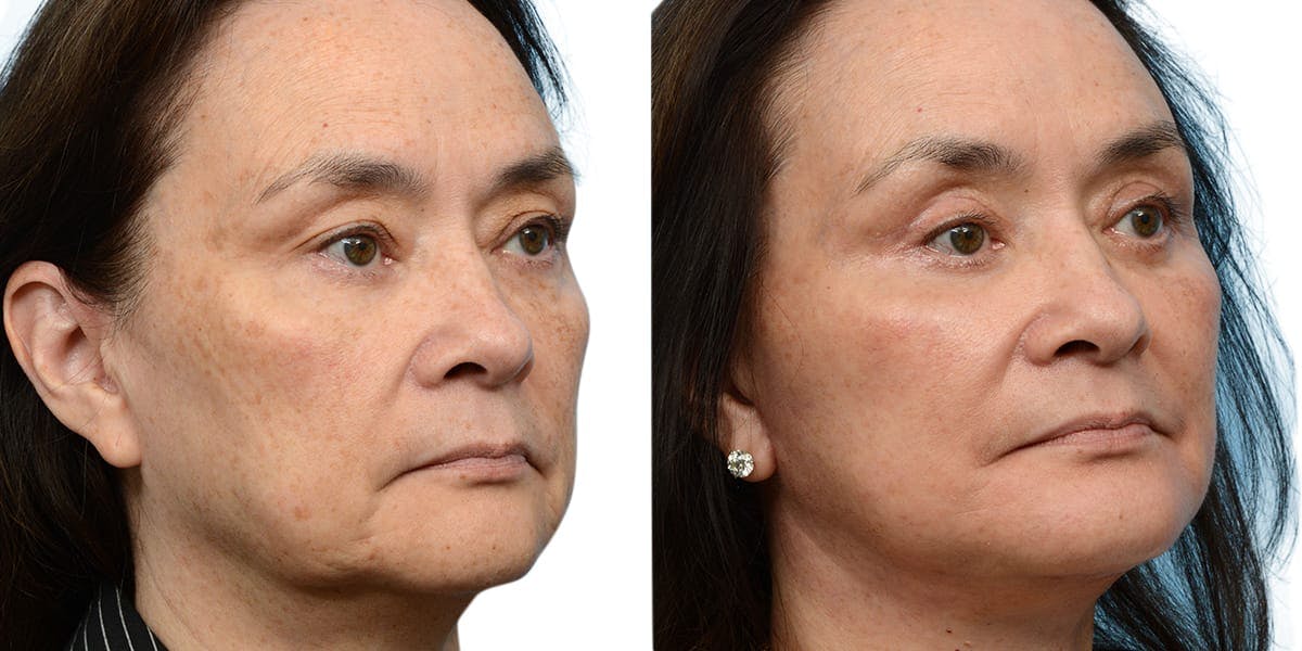 CO2 Laser Before & After Gallery - Patient 575206 - Image 2