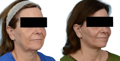 CO2 Laser Before & After Gallery - Patient 291194 - Image 1