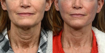 CO2 Laser Before & After Gallery - Patient 267395 - Image 1