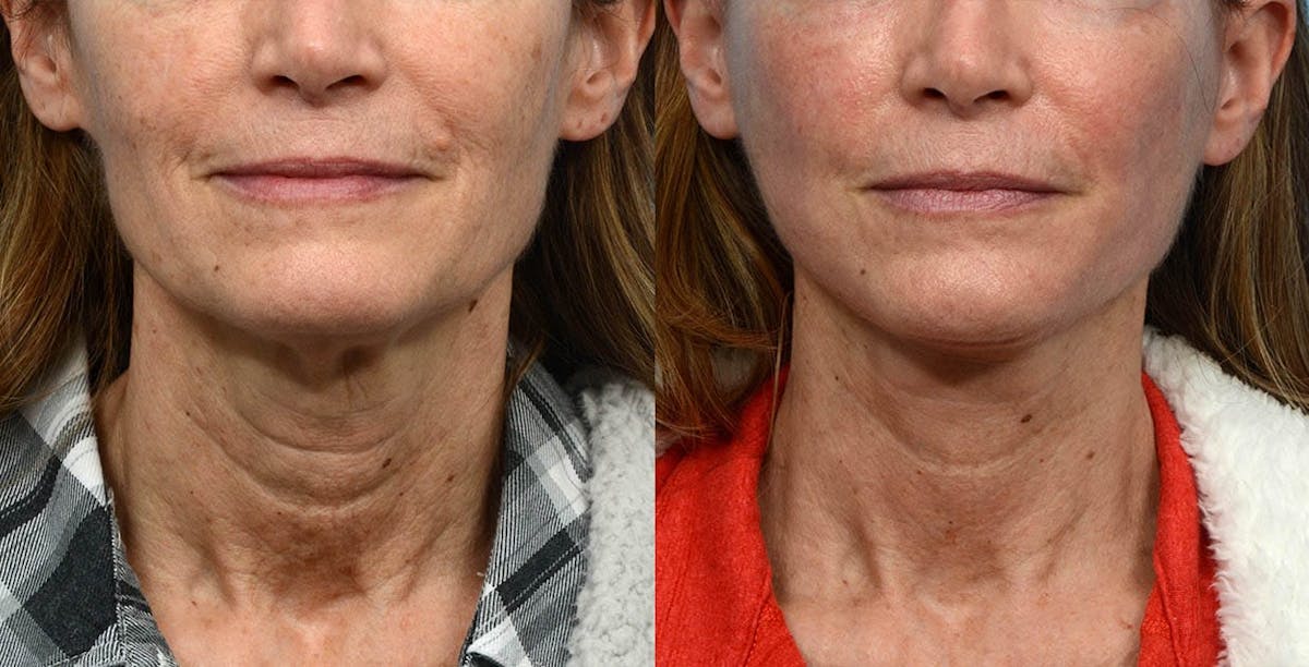 CO2 Laser Before & After Gallery - Patient 267395 - Image 1