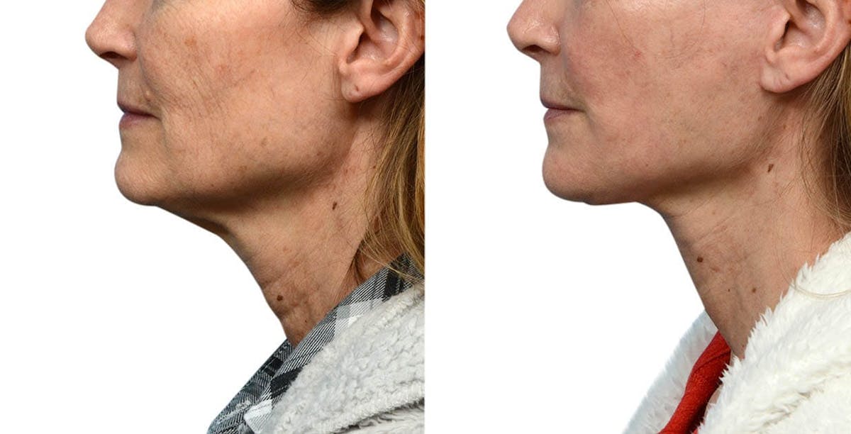 CO2 Laser Before & After Gallery - Patient 267395 - Image 2