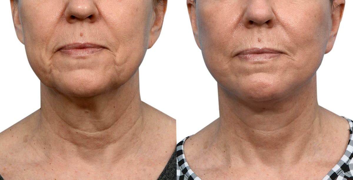 CO2 Laser Before & After Gallery - Patient 131363 - Image 1