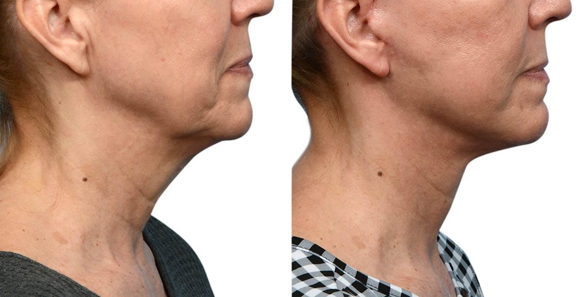 CO2 Laser Before & After Gallery - Patient 131363 - Image 2