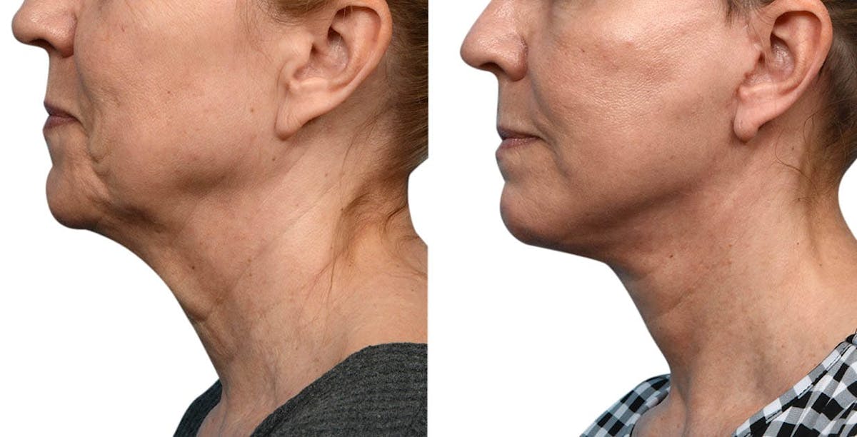 CO2 Laser Before & After Gallery - Patient 131363 - Image 3