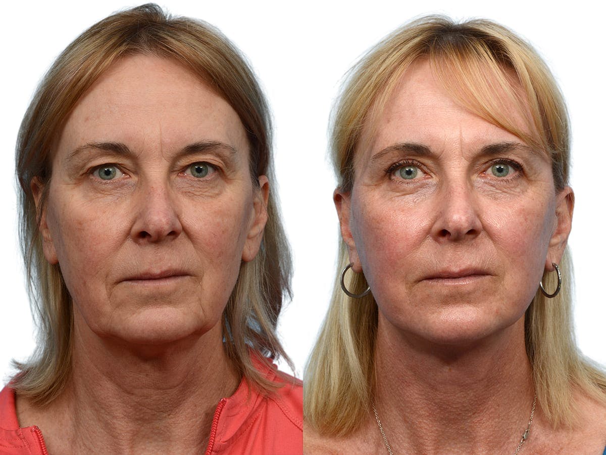 CO2 Laser Before & After Gallery - Patient 276857 - Image 1