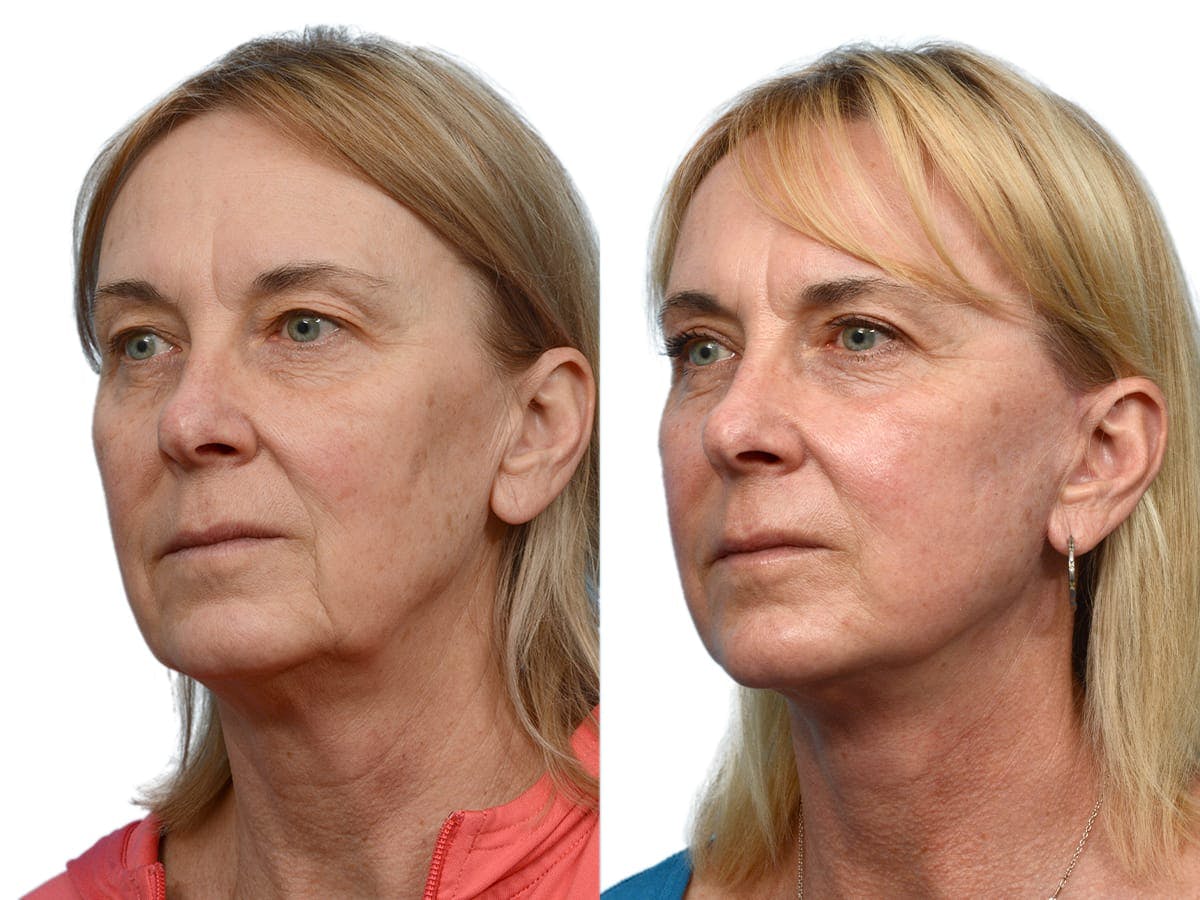 CO2 Laser Before & After Gallery - Patient 276857 - Image 2