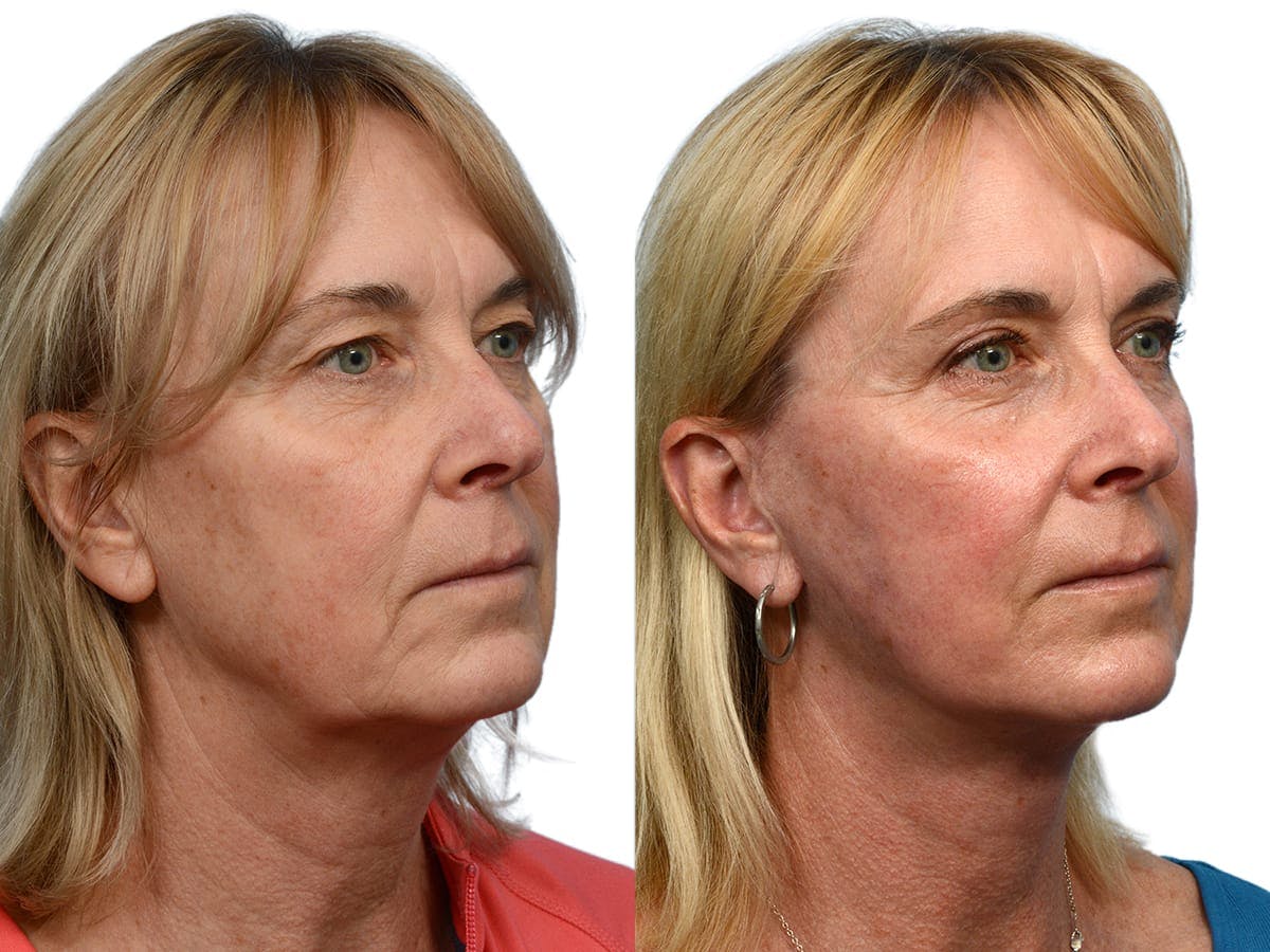 CO2 Laser Before & After Gallery - Patient 276857 - Image 4