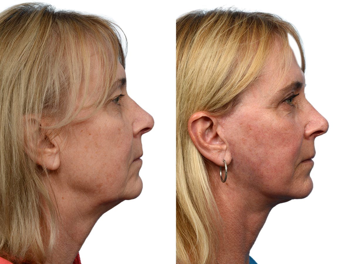 CO2 Laser Before & After Gallery - Patient 276857 - Image 5