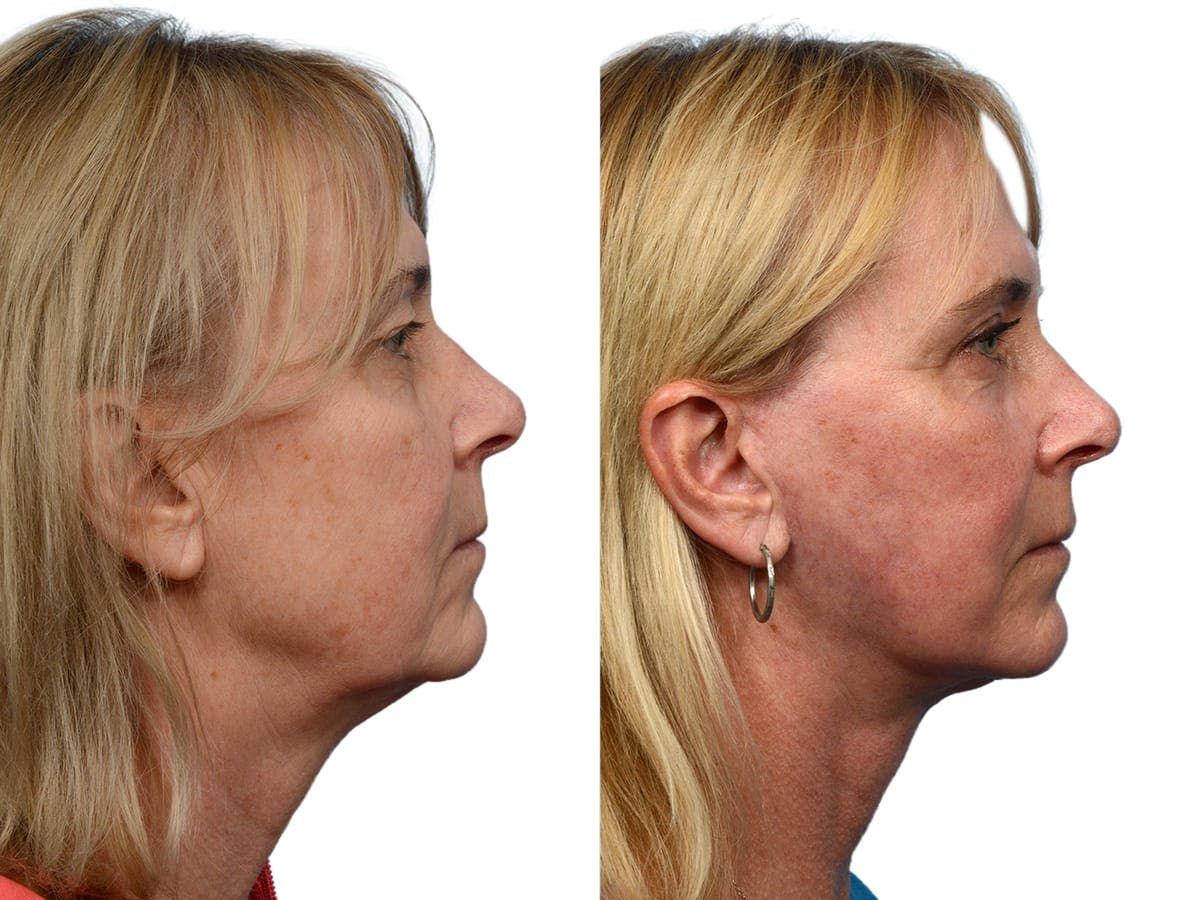 CO2 Laser Before & After Gallery - Patient 276857 - Image 5
