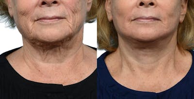 CO2 Laser Before & After Gallery - Patient 285737 - Image 1