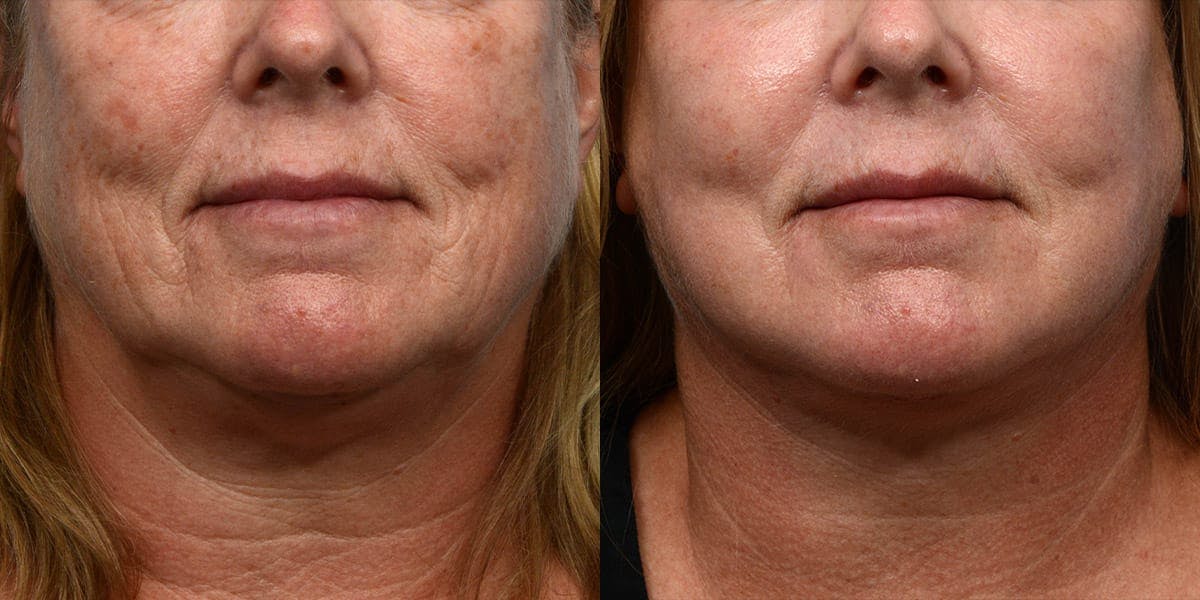 Facelift Before & After Gallery - Patient 205840 - Image 1