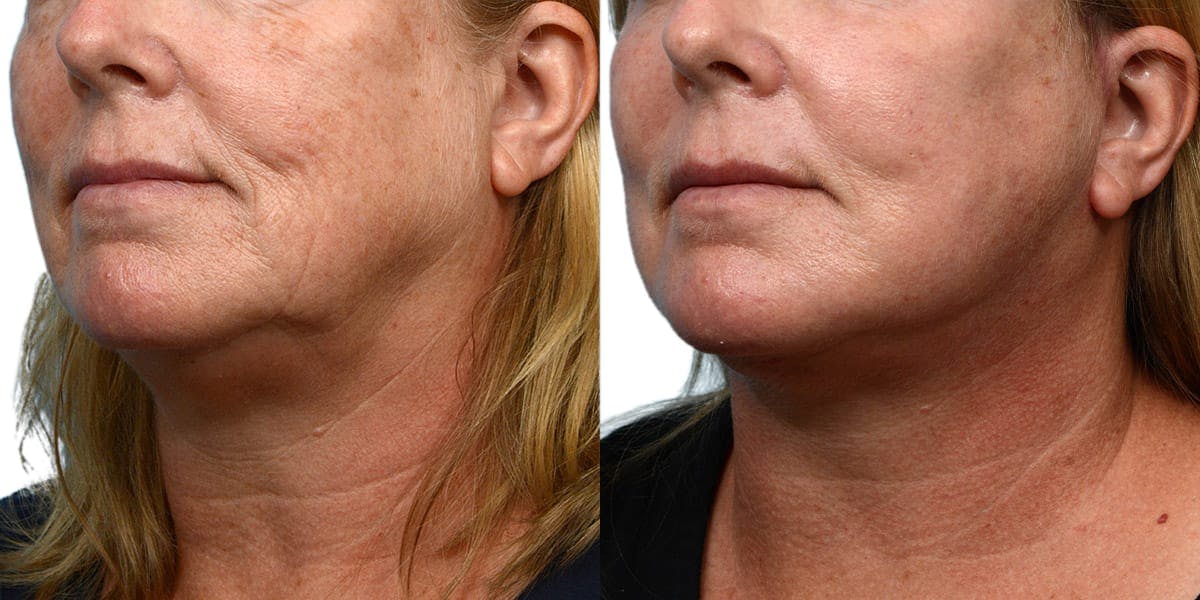 CO2 Laser Before & After Gallery - Patient 809040 - Image 2