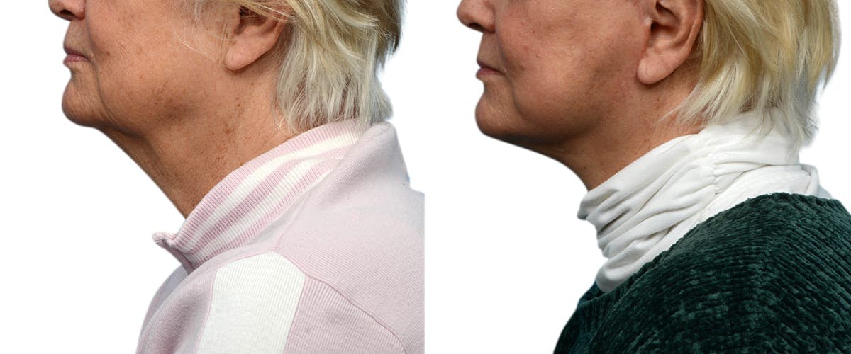 CO2 Laser Before & After Gallery - Patient 216556 - Image 2