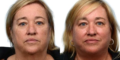 CO2 Laser Before & After Gallery - Patient 326149 - Image 1