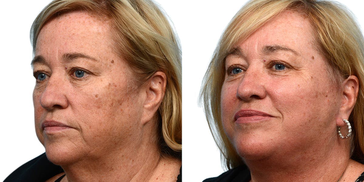 CO2 Laser Before & After Gallery - Patient 326149 - Image 2