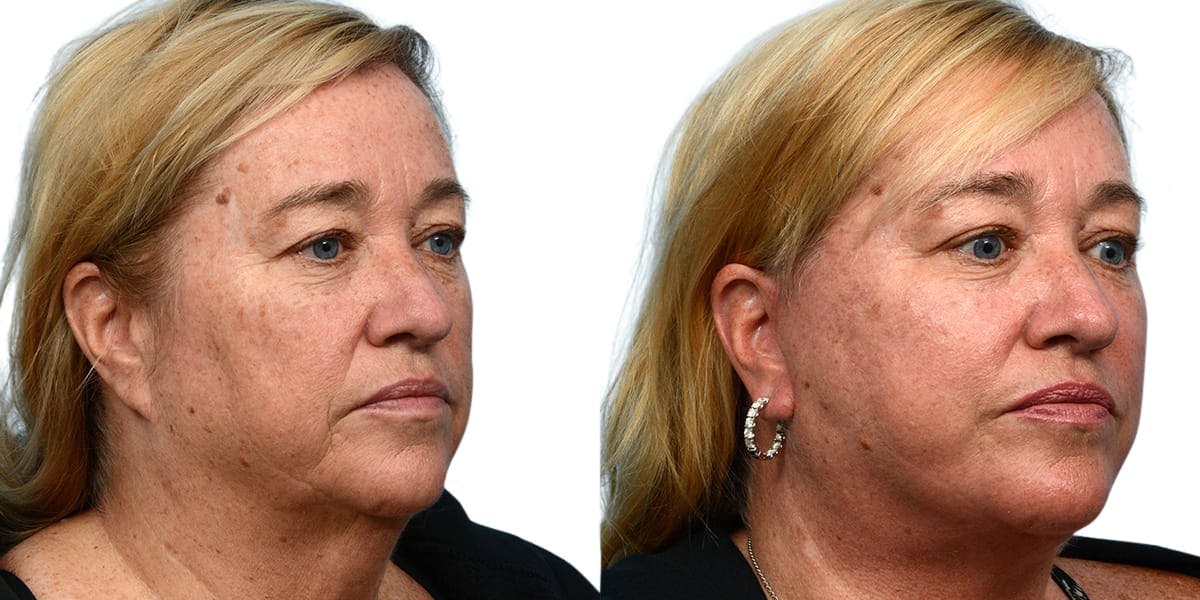 CO2 Laser Before & After Gallery - Patient 326149 - Image 3