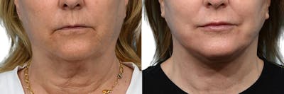 CO2 Laser Before & After Gallery - Patient 367047 - Image 1