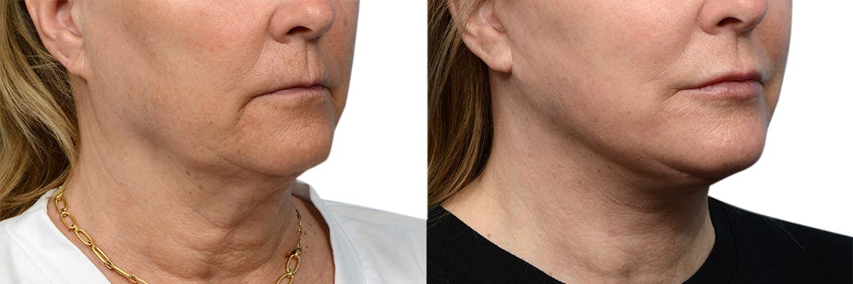 CO2 Laser Before & After Gallery - Patient 367047 - Image 2