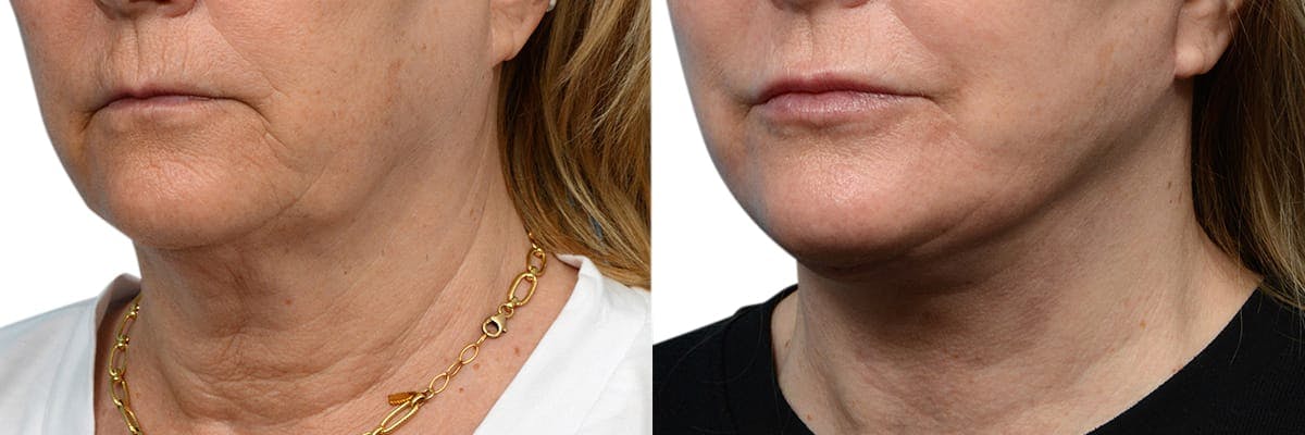 CO2 Laser Before & After Gallery - Patient 367047 - Image 3