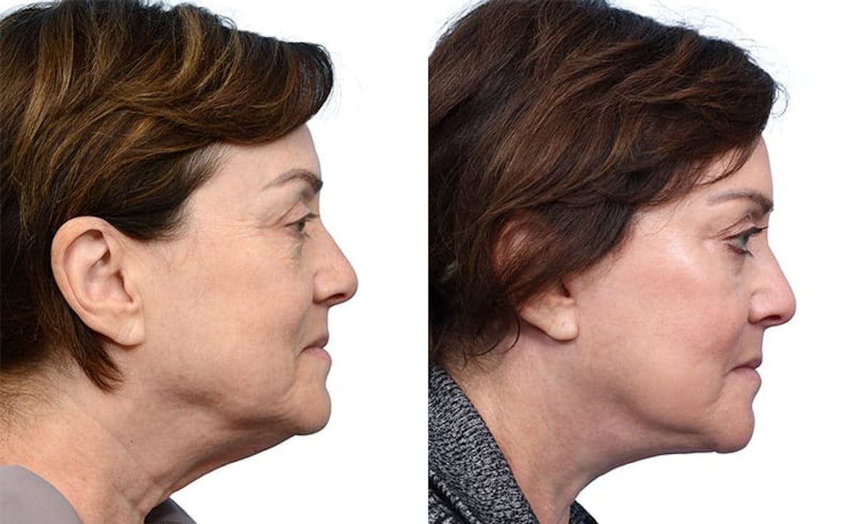 Deep Plane Facelift Before & After Gallery - Patient 164807 - Image 1