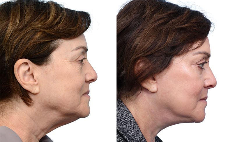 CO2 Laser Before & After Gallery - Patient 213532 - Image 1