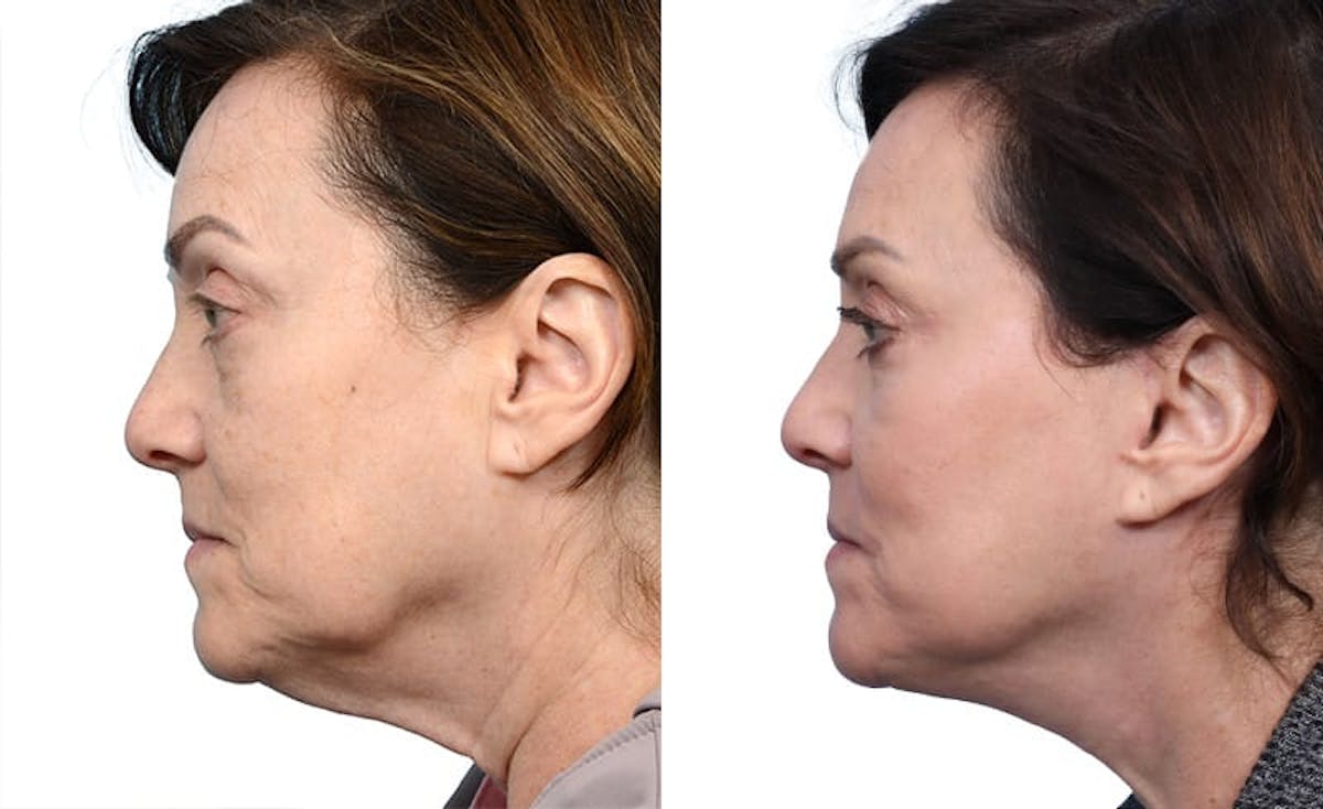 Deep Plane Facelift Before & After Gallery - Patient 164807 - Image 2