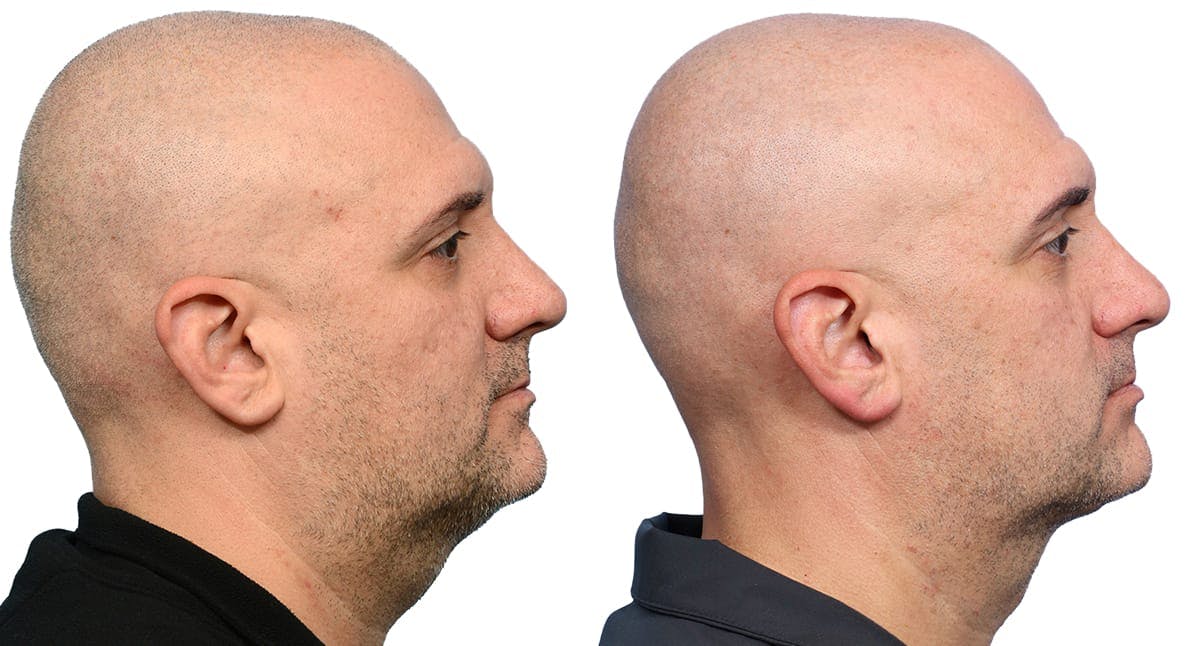 Submentoplasty Before & After Gallery - Patient 163166 - Image 1