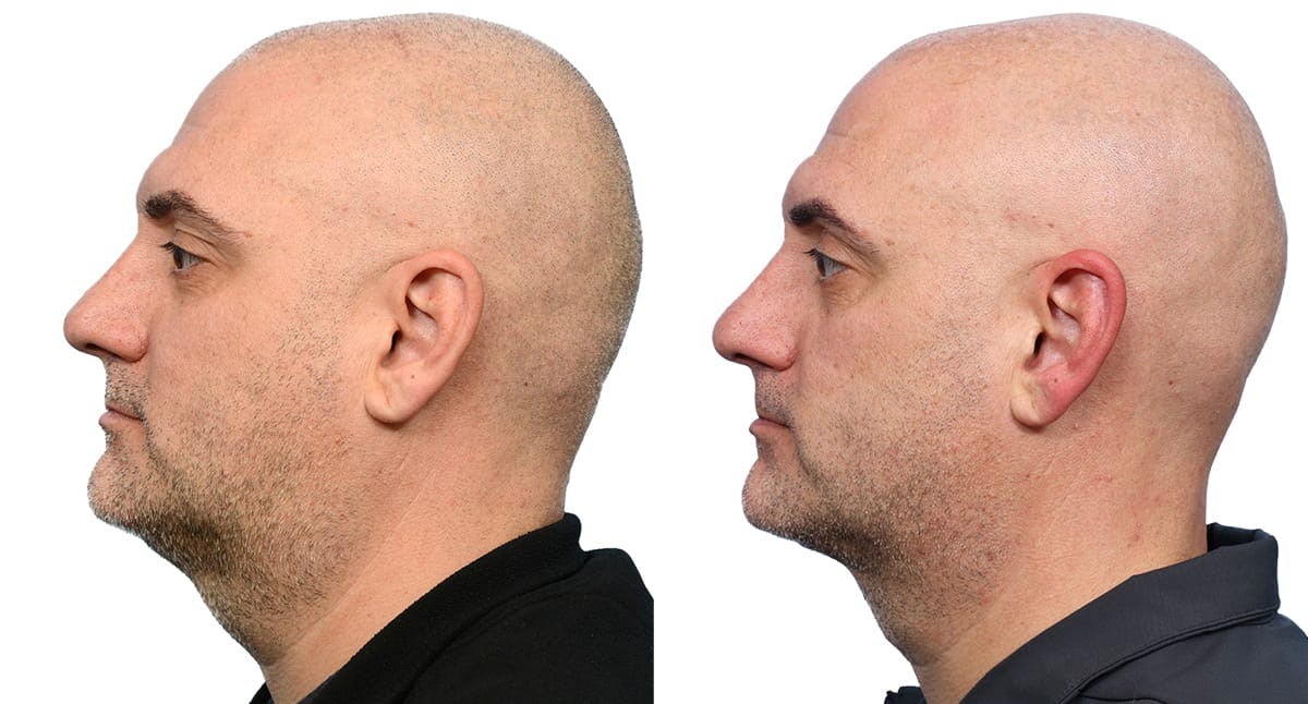 Deep Neck Lift Before & After Gallery - Patient 403785 - Image 2