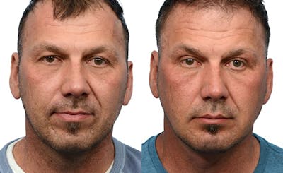Deep Neck Lift Before & After Gallery - Patient 121857 - Image 1