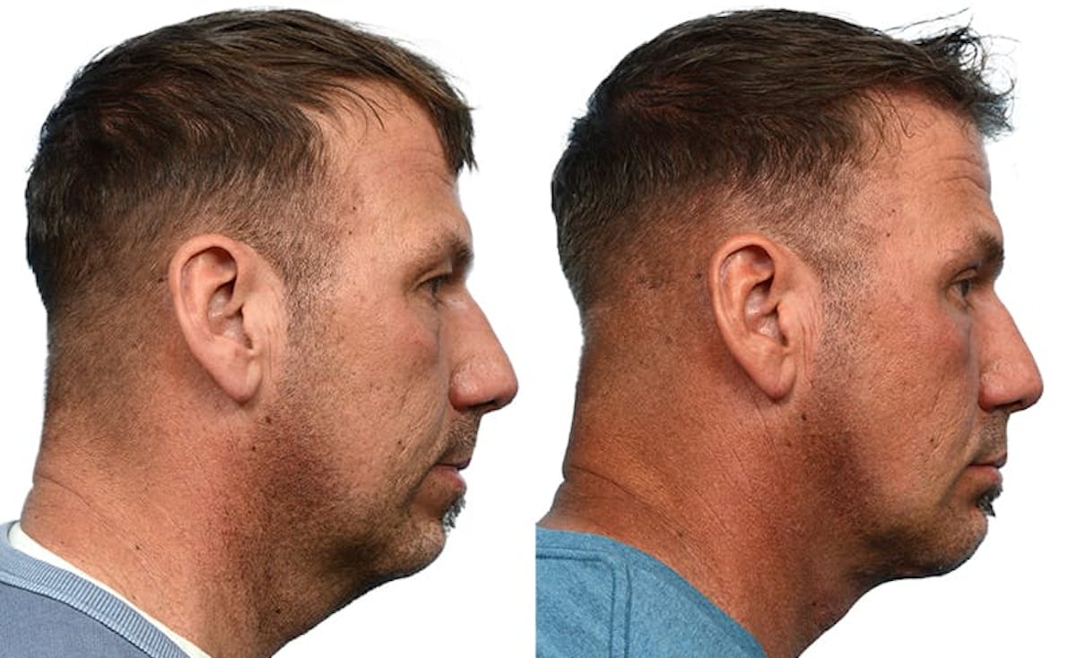 Deep Neck Lift Before & After Gallery - Patient 121857 - Image 2