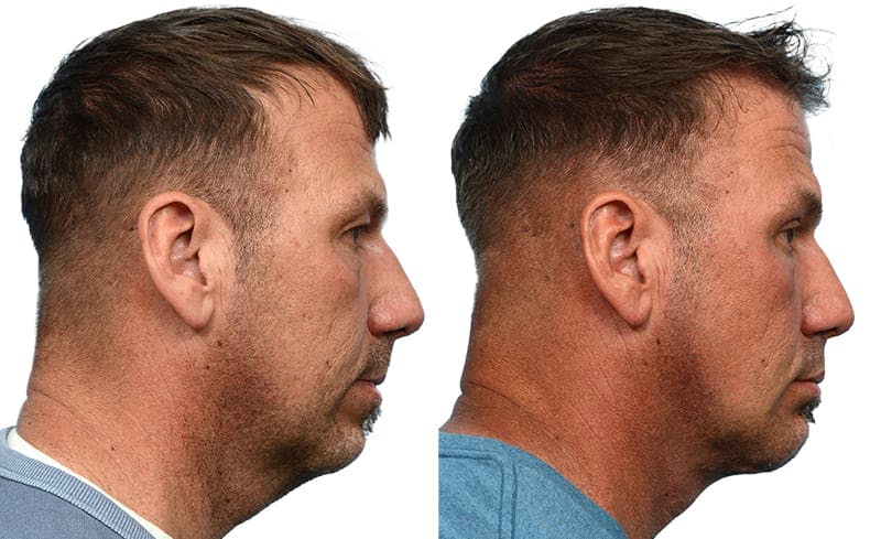 Deep Neck Lift Before & After Gallery - Patient 121857 - Image 2
