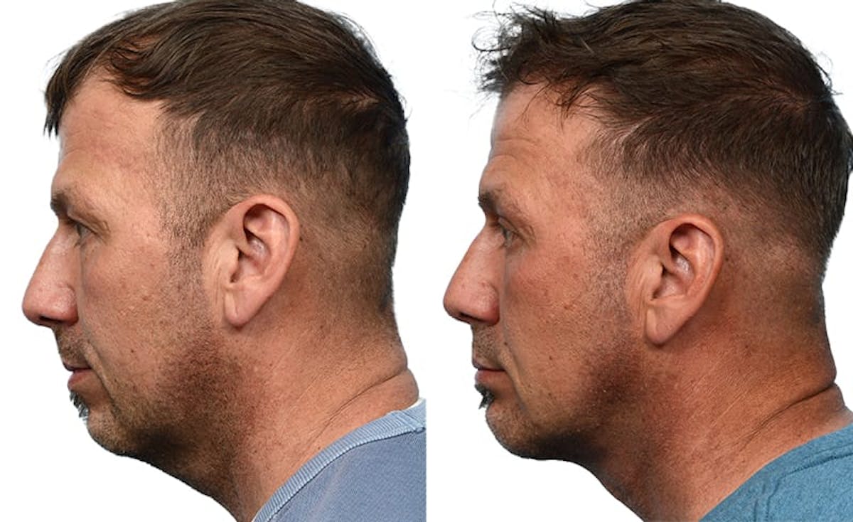 Deep Neck Lift Before & After Gallery - Patient 121857 - Image 3