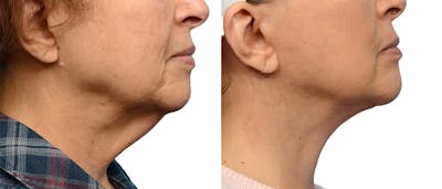 Deep Neck Lift Before & After Gallery - Patient 429356 - Image 1