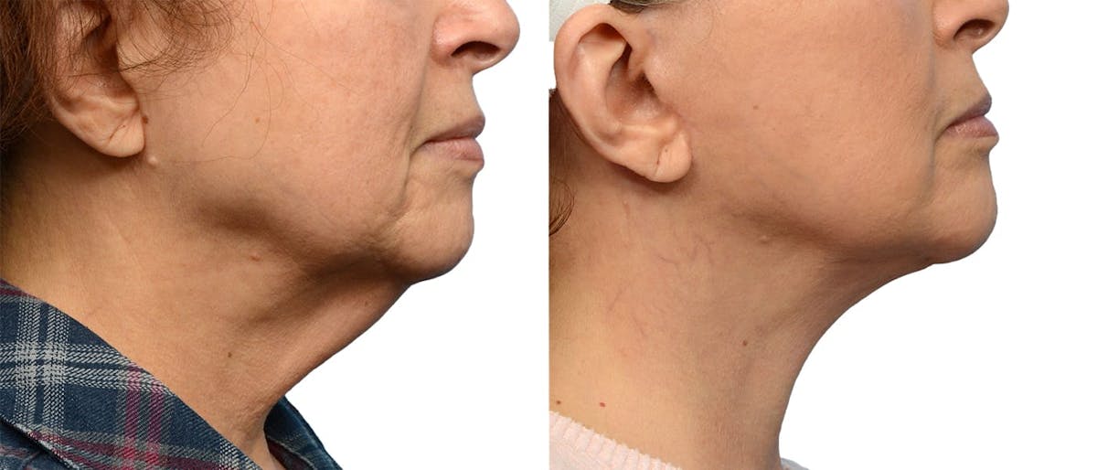 Deep Neck Lift Before & After Gallery - Patient 429356 - Image 1