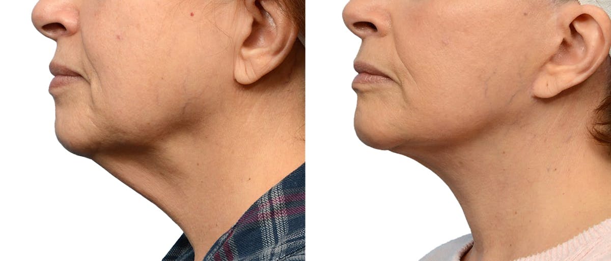 Deep Neck Lift Before & After Gallery - Patient 429356 - Image 2