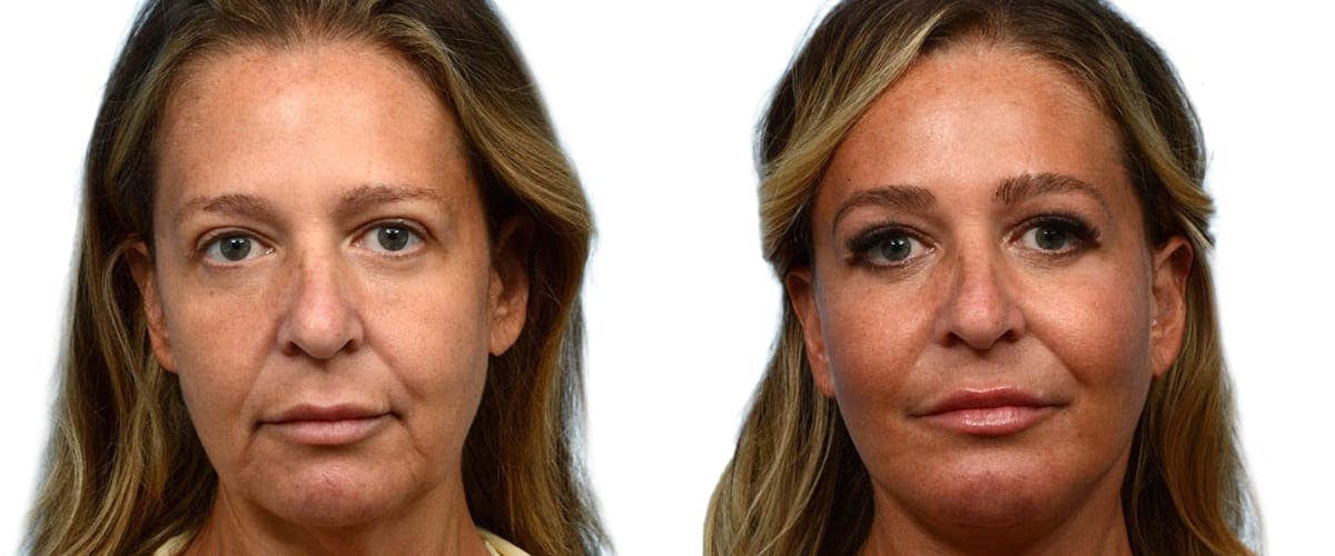 Deep Plane Facelift Before & After Gallery - Patient 152132 - Image 1