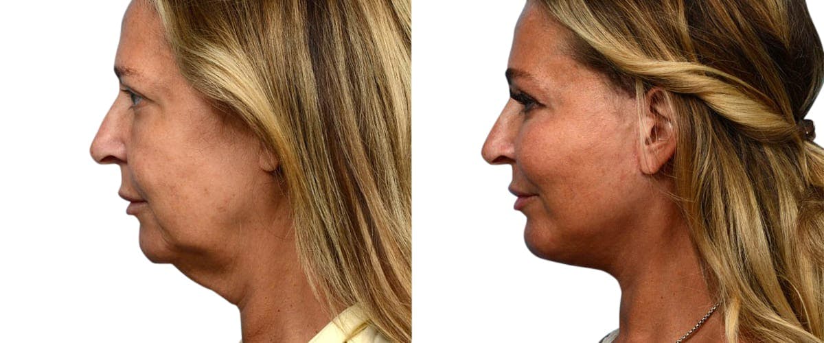 Deep Plane Facelift Before & After Gallery - Patient 152132 - Image 3