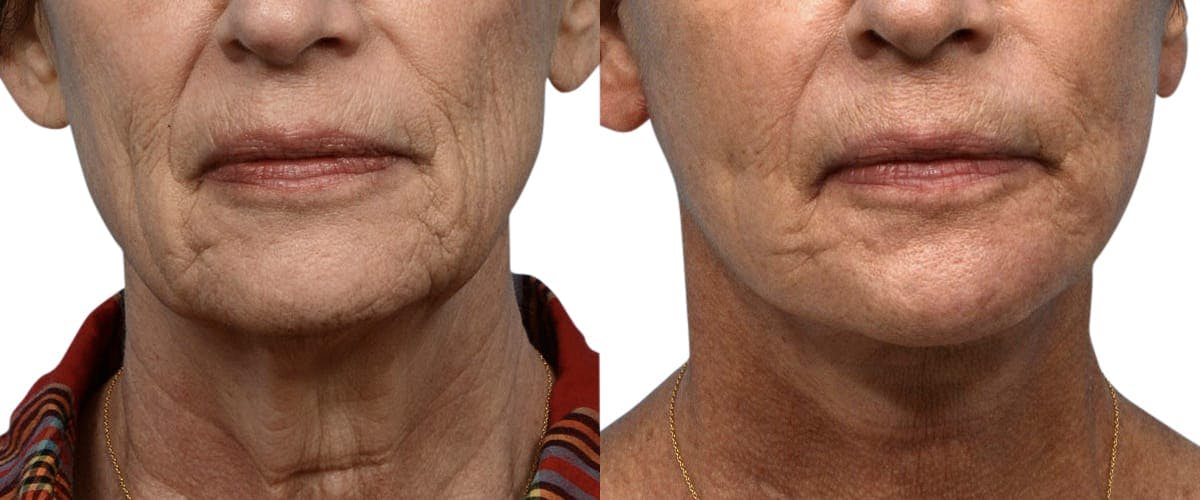 Deep Plane Facelift Before & After Gallery - Patient 110991 - Image 1