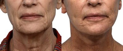 Deep Plane Facelift Before & After Gallery - Patient 110991 - Image 1
