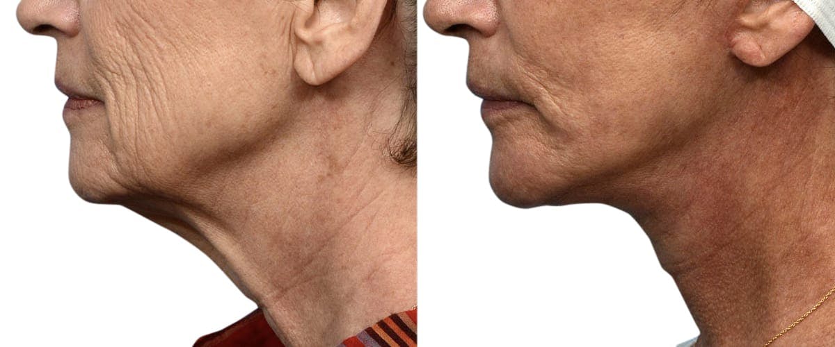 Deep Plane Facelift Before & After Gallery - Patient 110991 - Image 2