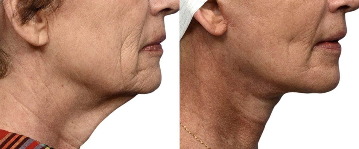 Deep Plane Facelift Before & After Gallery - Patient 110991 - Image 3