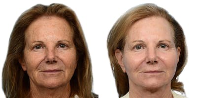 Deep Plane Facelift Before & After Gallery - Patient 394030 - Image 1