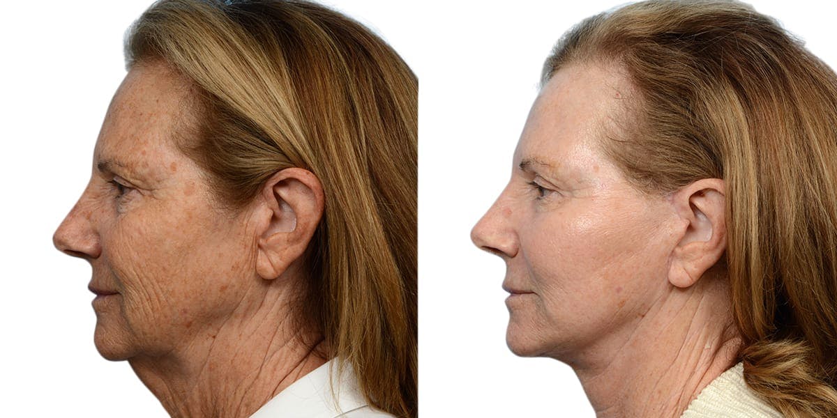 Deep Plane Facelift Before & After Gallery - Patient 394030 - Image 2