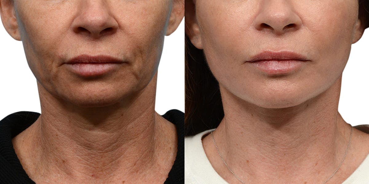 Deep Plane Facelift Before & After Gallery - Patient 203275 - Image 1