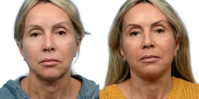 Deep Plane Facelift Before & After Gallery - Patient 420748 - Image 1