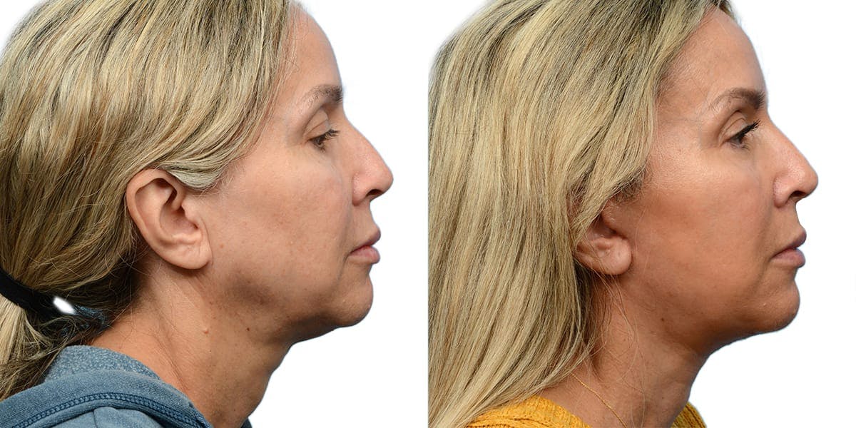 Deep Plane Facelift Before & After Gallery - Patient 420748 - Image 2