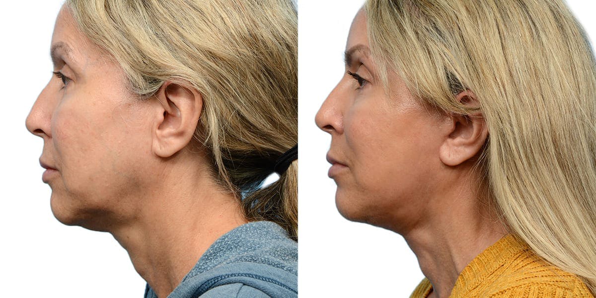 Deep Plane Facelift Before & After Gallery - Patient 420748 - Image 3